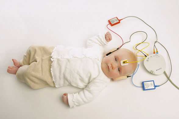 کم شنوایی در نوزادان 